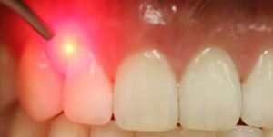 implant dentar cu laser
